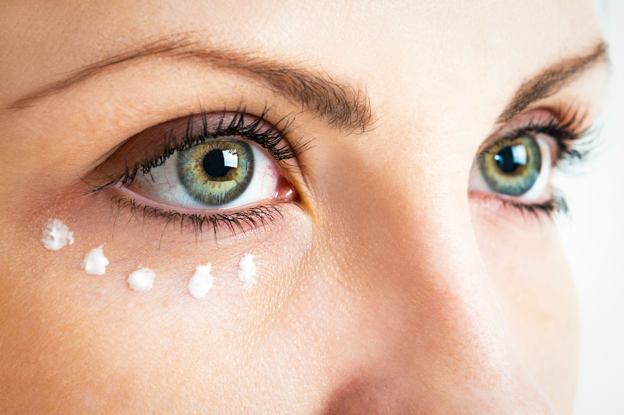 Dark Eye Circles Removal: How It Is Done without Surgery