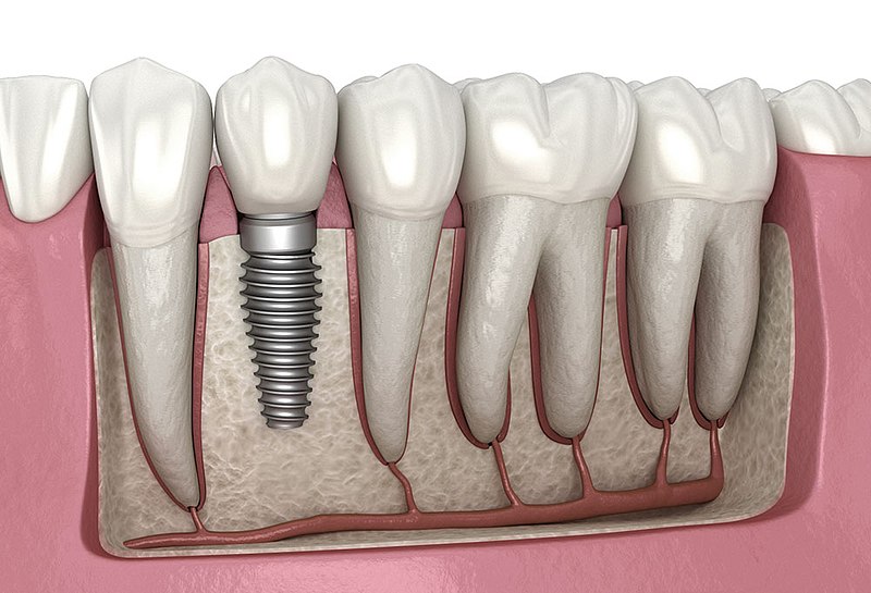 Dentures vs. Dental Implants: Which is the Right Choice for You?