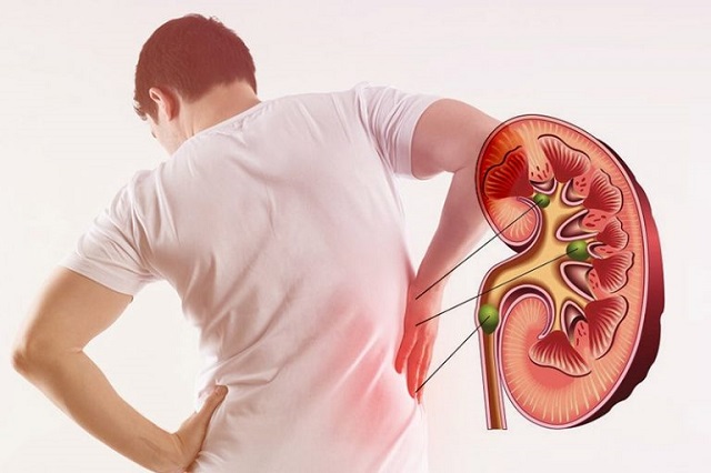 How to Avoid Future Kidney Stones and Other Problems After Treatment